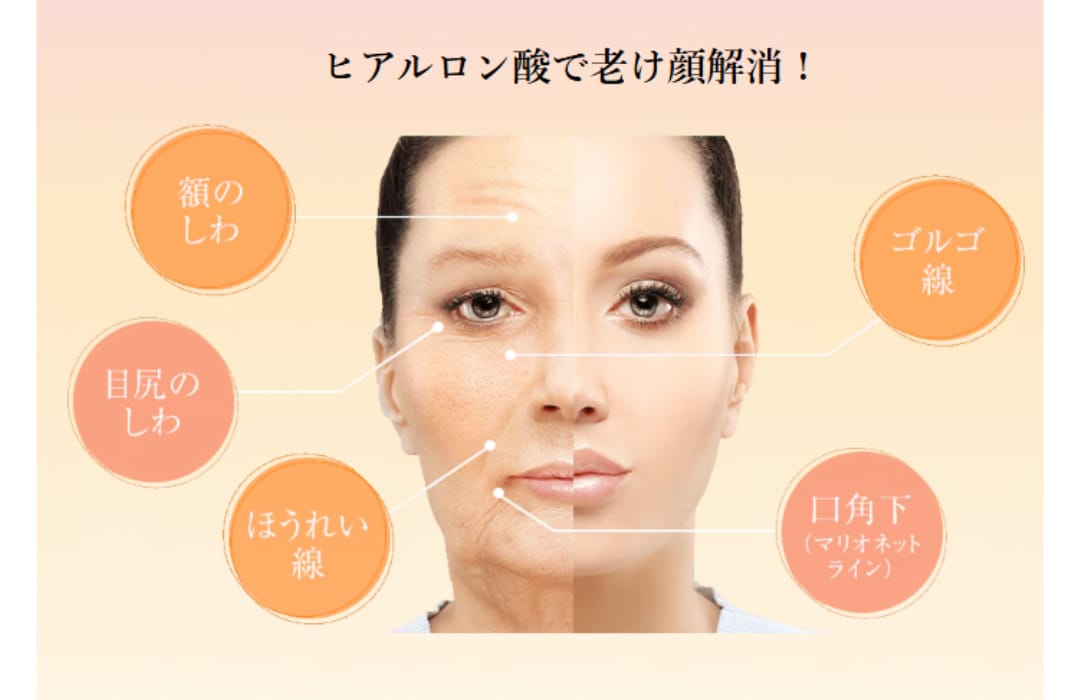 ヒアルロン酸でできる若返り治療とは？